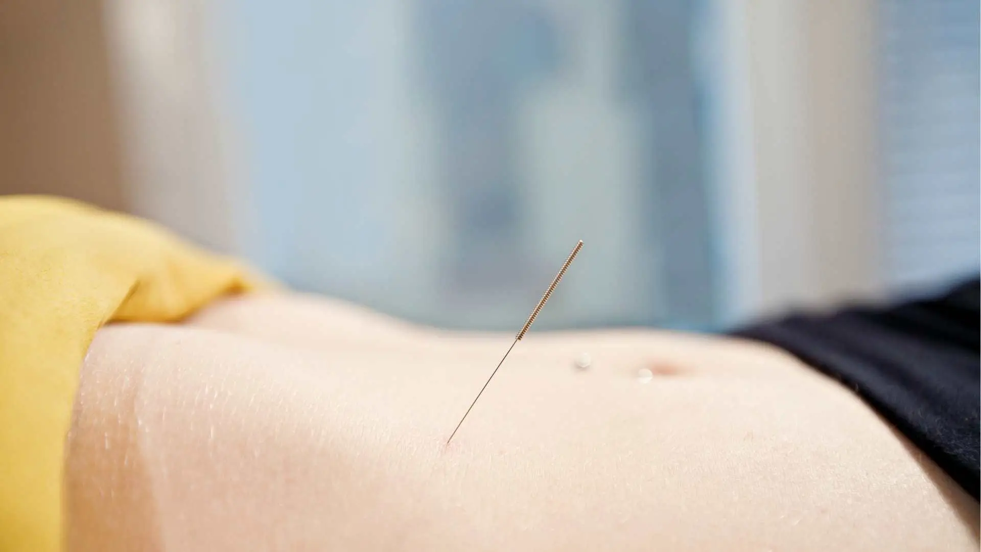 Mujer recibiendo acupuntura para mejorar su fertilidad