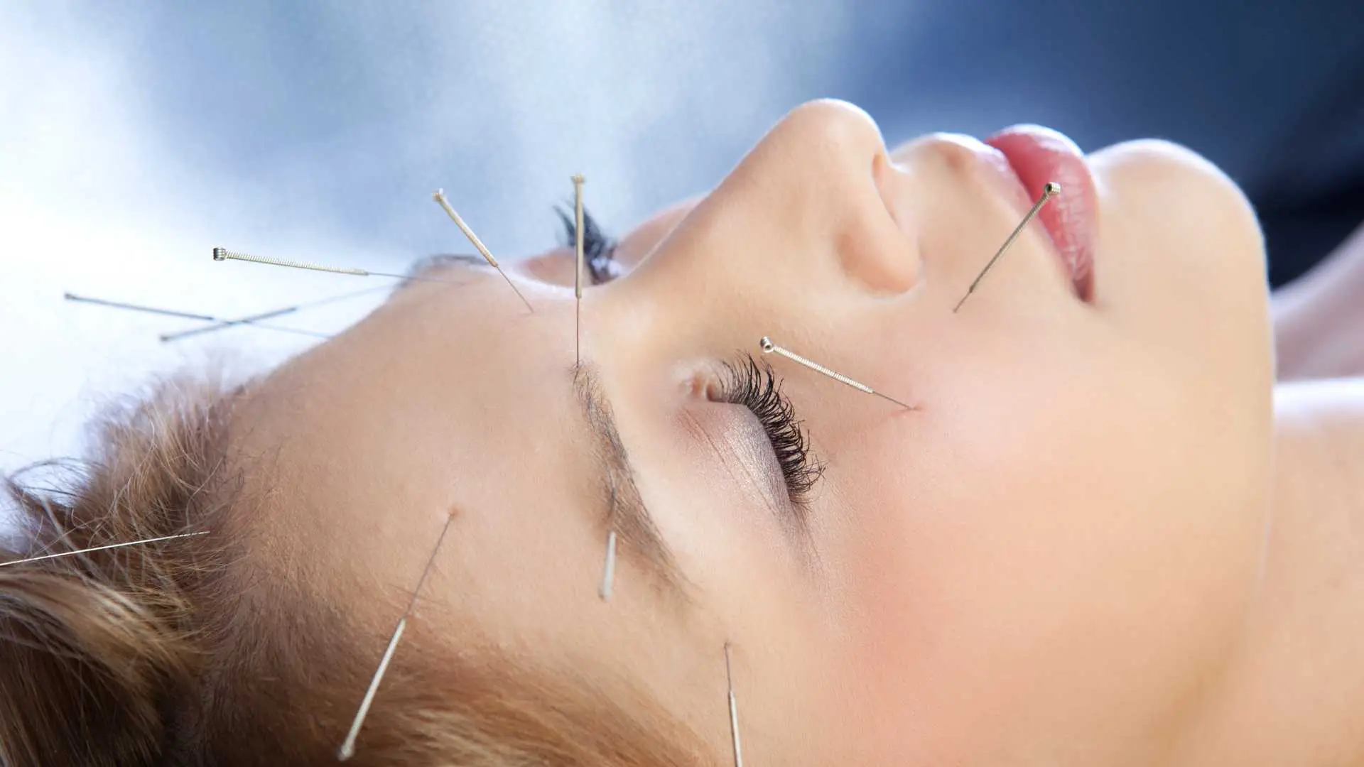 Mujer recibiendo tratamiento de acupuntura facial en el rostro
