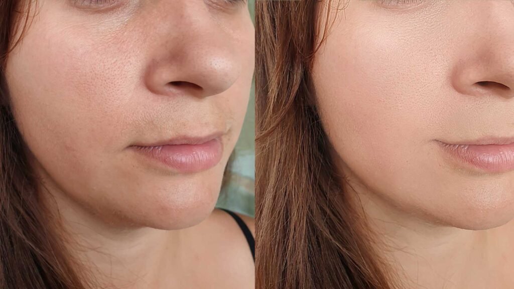 Comparación del rostro femenino antes y después de sesiones de acupuntura