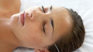acupuntura en el rostro mostrando aguja delgada e indolora