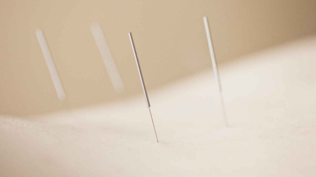 aguja de acupuntura insertada superficialmente sin causar dolor